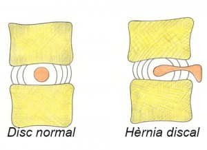 Mètode Pilates, un gran aliat per a la nostra hèrnia discal
