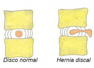 Hernia discal