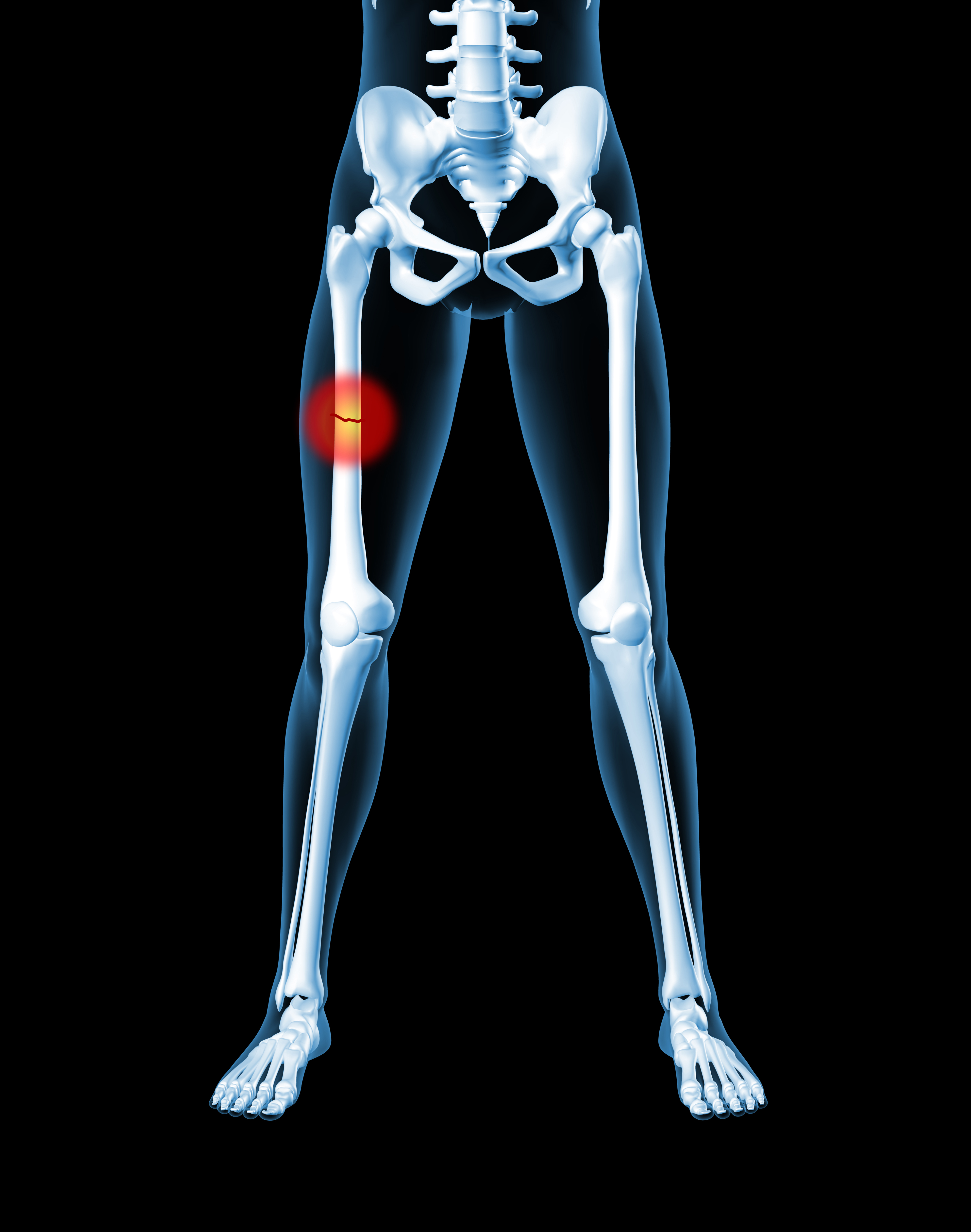 Переломы скелета. Женский скелет. Скелет женских бедер. Скелет человека с переломом костей. Скелет человека бедро.