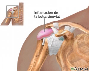 Lesión hombro_Manguito de los rotadores: tendinitis del supraespinoso no traumática