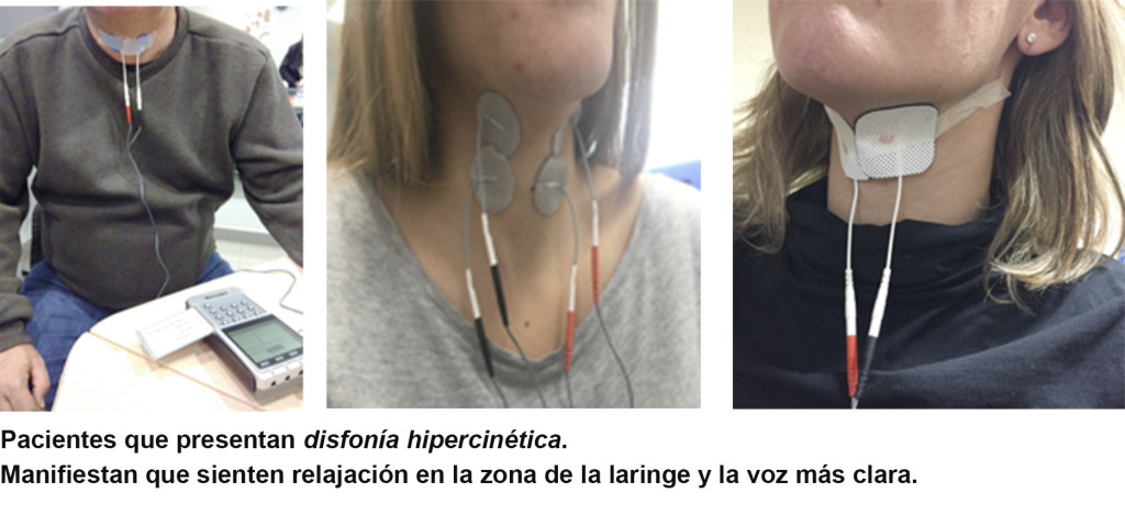 electroestimulación