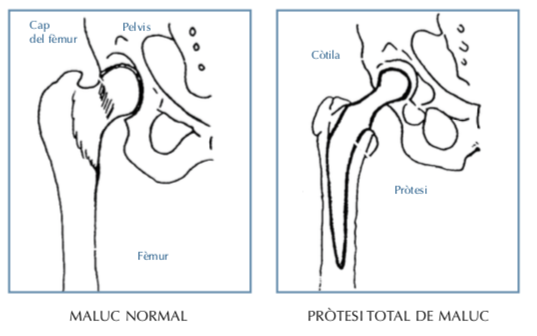 prótesis de cadera