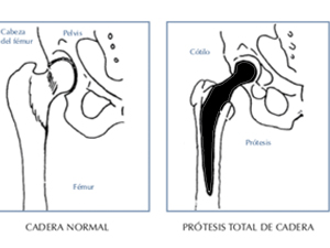 primeros cuidados de una prótesis de cadera